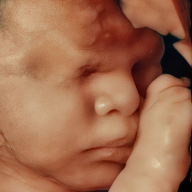 Ultrassonografia 3d 4d Fertilivita Reproducao Humana